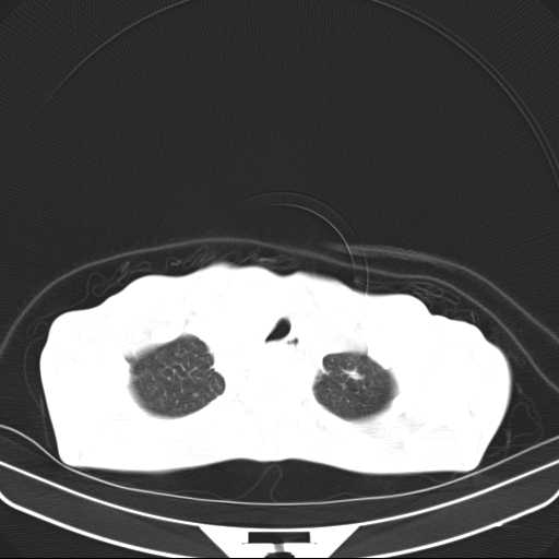 File:Non hodgkin lymphoma of the mediastinum (Radiopaedia 20814-20729 Axial lung window 8).jpg