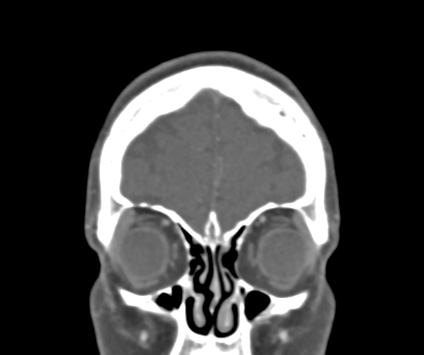 File:Normal CTA head (Radiopaedia 40801-43464 B 18).png