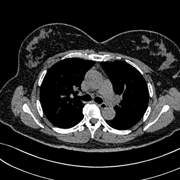 Normal CT chest- adult female (Radiopaedia 52522-58428 Axial non-contrast 52).jpg