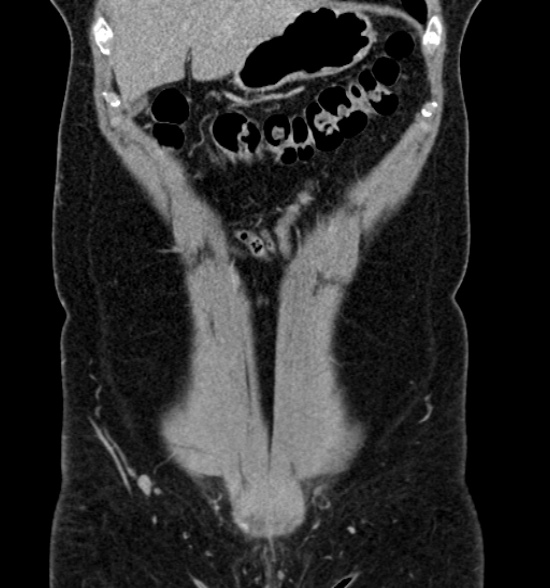 File:Normal CT intravenous urogram (Radiopaedia 39444-41759 A 191).jpg