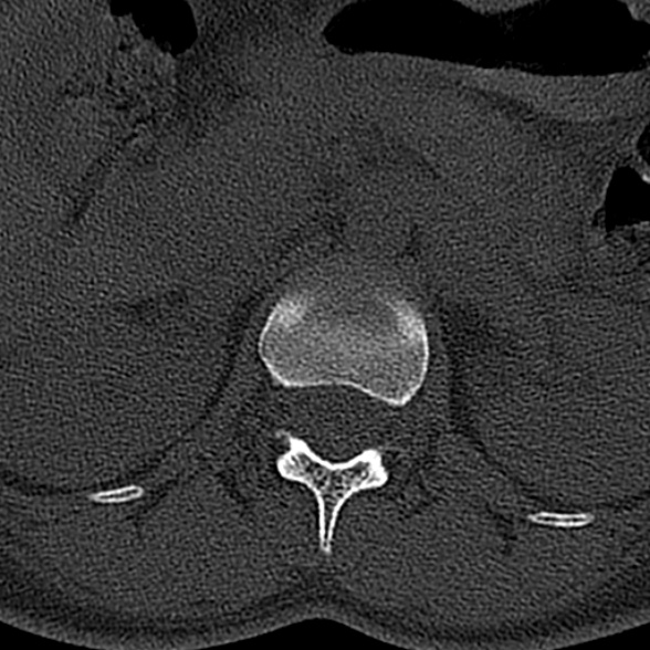 File:Normal CT lumbar spine (Radiopaedia 53981-60118 Axial bone window 15).jpg