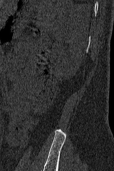 File:Normal CT lumbar spine (Radiopaedia 53981-60118 Sagittal bone window 104).jpg