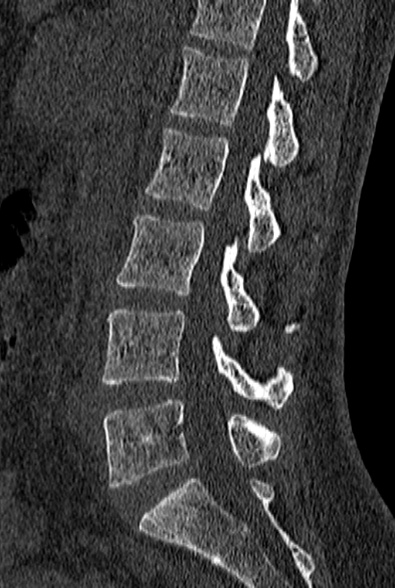 File:Normal CT lumbar spine (Radiopaedia 53981-60118 Sagittal bone window 44).jpg