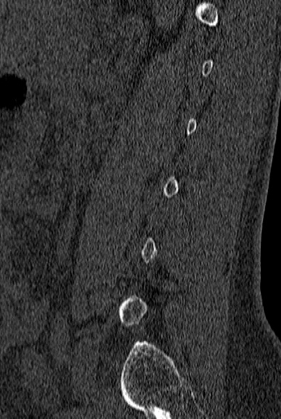 File:Normal CT lumbar spine (Radiopaedia 53981-60118 Sagittal bone window 72).jpg