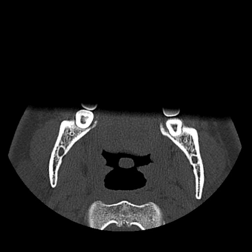 Normal CT paranasal sinuses (Radiopaedia 42286-45390 Axial bone window 119).jpg