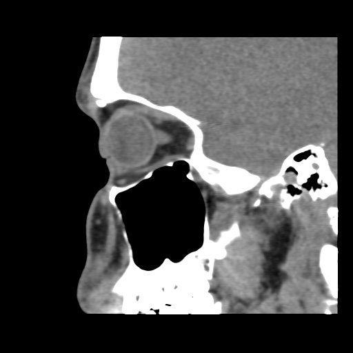 Normal CT paranasal sinuses (Radiopaedia 42286-45390 F 103).jpg