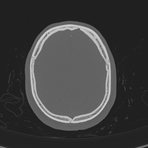 Normal CT skull (Radiopaedia 40798-43459 A 128).png