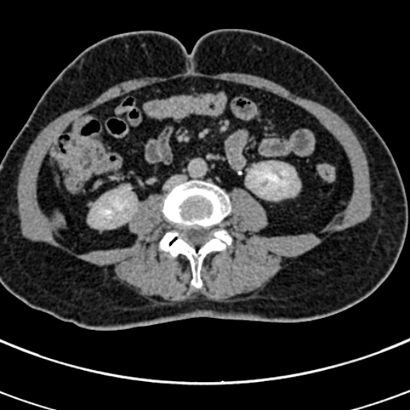File:Normal CT split bolus study of the renal tract (Radiopaedia 48631-53634 Axial split bolus 144).jpg