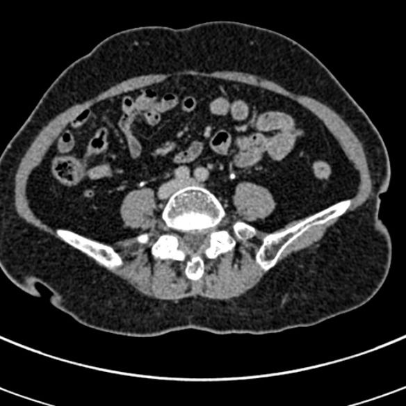 File:Normal CT split bolus study of the renal tract (Radiopaedia 48631-53634 Axial split bolus 176).jpg