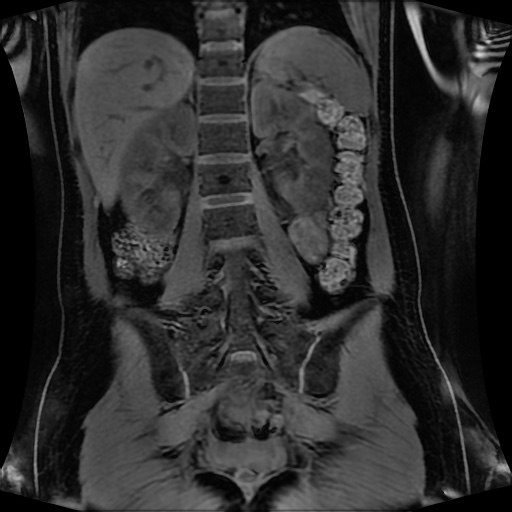 Normal MRI abdomen in pregnancy (Radiopaedia 88001-104541 M 94).jpg