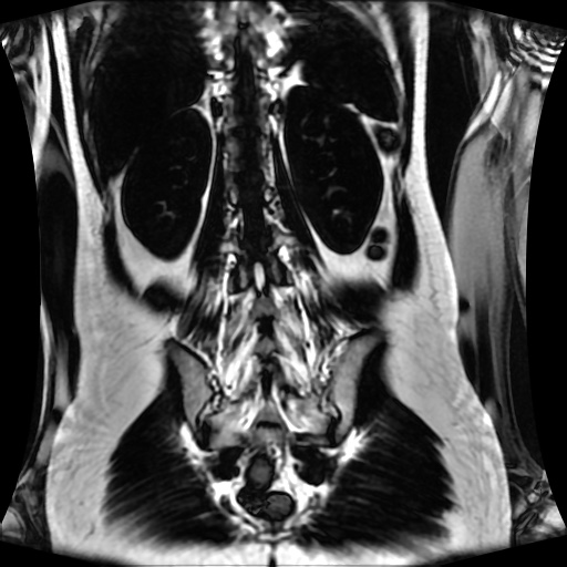 Normal MRI abdomen in pregnancy (Radiopaedia 88001-104541 N 105).jpg