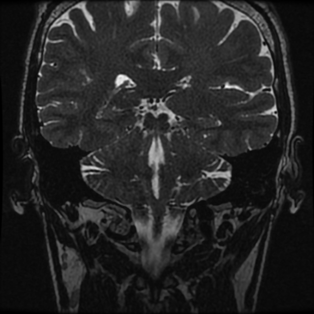 Normal MRI petrous (Radiopaedia 91317-108949 Coronal T2 77).jpg