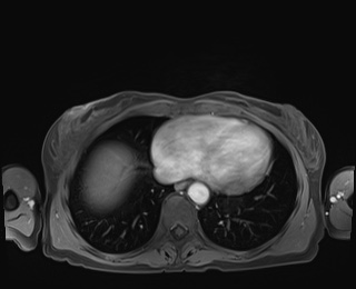 Normal adrenal glands MRI (Radiopaedia 82017-96004 M 3).jpg