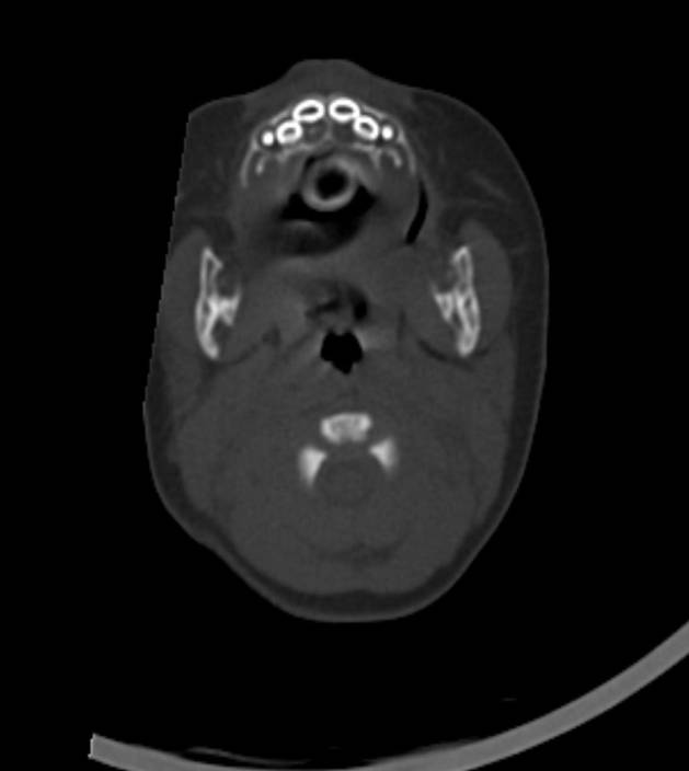 Normal brain CT - 2-month-old (Radiopaedia 53369-59350 Axial bone window 60).jpg