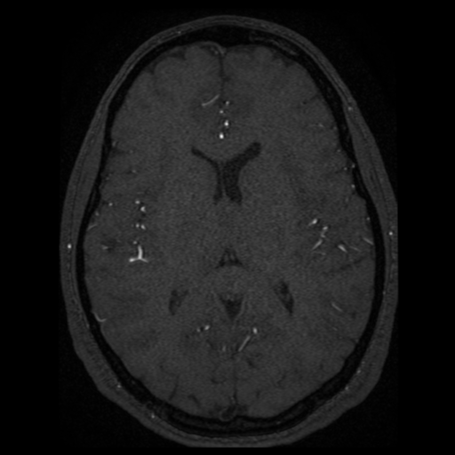 Normal brain MRA (Radiopaedia 41046-43793 Axial MRA 13).png