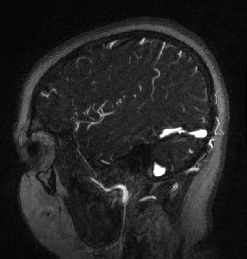 Normal brain MRI and venogram (Radiopaedia 39554-41862 Sagittal MRV 53).jpg