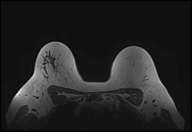 File:Normal breast MRI - dense breasts (Radiopaedia 80454-93850 Axial T1 171).jpg