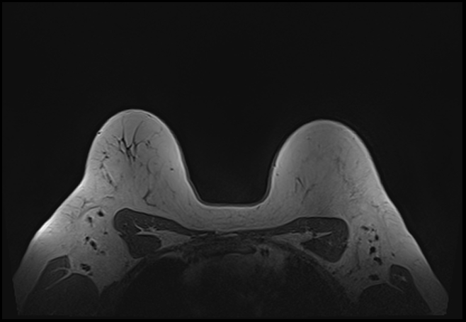 File:Normal breast MRI - dense breasts (Radiopaedia 80454-93850 Axial T1 179).jpg