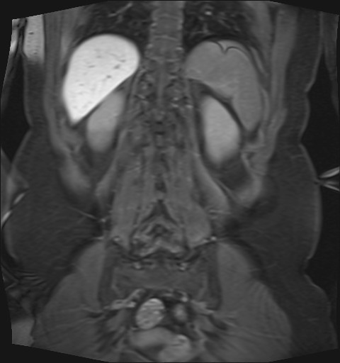 File:Normal hepatobiliary phase liver MRI (Radiopaedia 58968-66230 B 9).jpg
