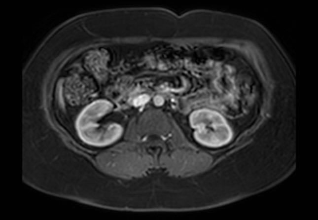 Normal liver MRI with Gadolinium (Radiopaedia 58913-66163 J 16).jpg