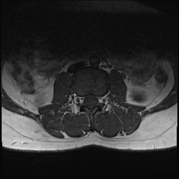 File:Normal lumbar spine MRI- 3 T (Radiopaedia 53280-59250 Axial 7).jpg