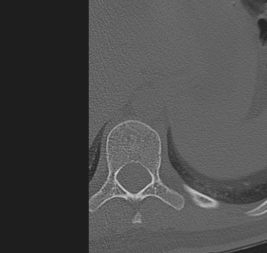 File:Normal lumbosacral CT (Radiopaedia 37923-39867 Axial bone window 2).png
