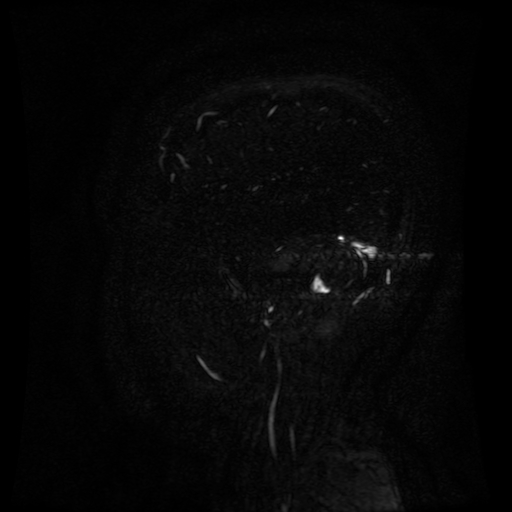 Normal noncontrast MR venography (Radiopaedia 87578-103957 A 27).jpg
