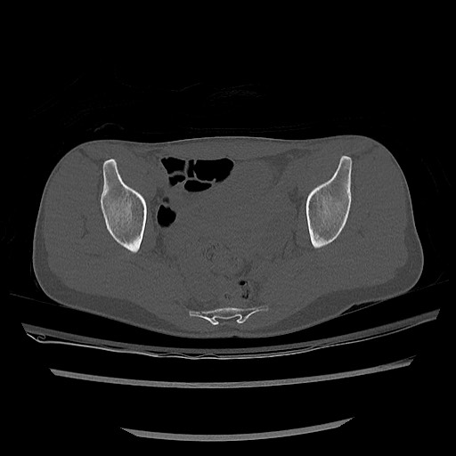 Normal pelvis CT (Radiopaedia 51471-57236 Axial bone window 59).jpg
