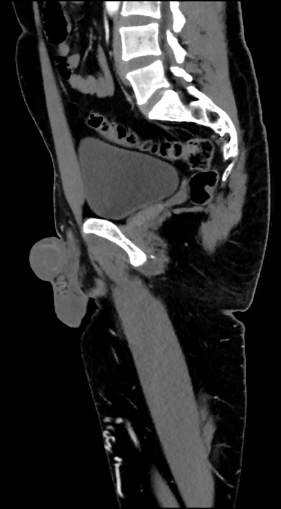 Normal pelvis CT angiogram (Radiopaedia 84966-100481 C 60).jpg