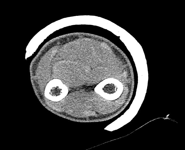 Normal wrist CT (Radiopaedia 41425-44297 Axial non-contrast 57).png