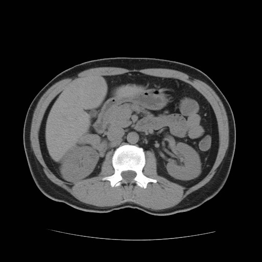 File:Obstructed kidney with perinephric urinoma (Radiopaedia 26889-27067 Axial non-contrast 8).jpg