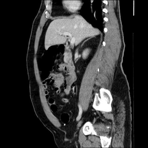 Obstructing ureteric calculus (Radiopaedia 49281-54373 C 58).jpg