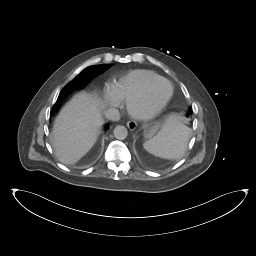 File:Obstructive pyelonephritis (Radiopaedia 46411-50844 Axial non-contrast 12).png