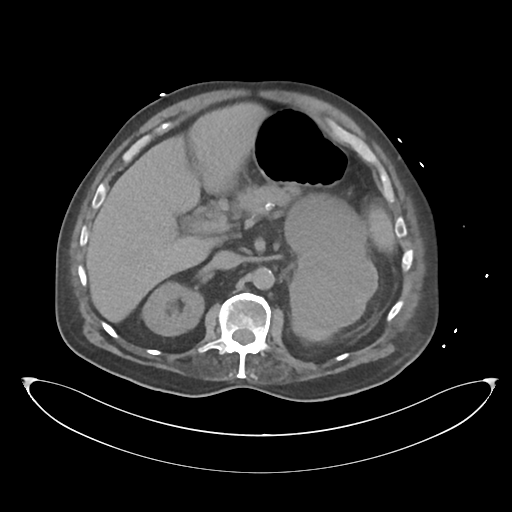 File:Obstructive pyelonephritis (Radiopaedia 46411-50844 Axial non-contrast 28).png