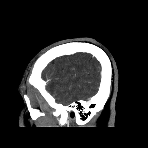 Occipital extradural hematoma simulating venous sinus thrombosis (Radiopaedia 46514-50964 D 68).jpg