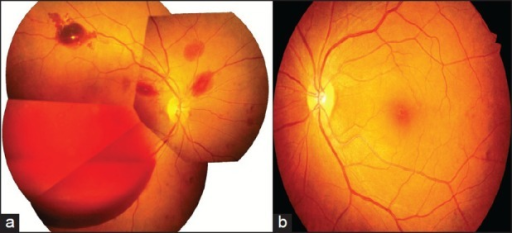 a) Right fundus with grade-1 hypertensive retinopathy changes (and subhyaloid hemorrhage) b) left fundus showing grade-1 hypertensive retinopathy changes (with absence of intraocular hemorrhages)