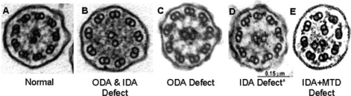 a-e)Diagnostic ciliary electron microscopy findings in primary ciliary dyskinesia