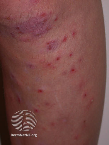 File:Superficial bacterial folliculitis (DermNet NZ acne-folliculitis2).jpg