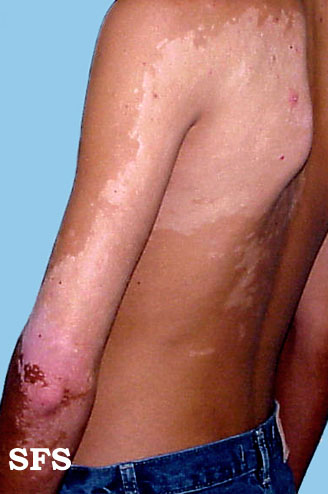 File:Vitiligo (Dermatology Atlas 13).jpg