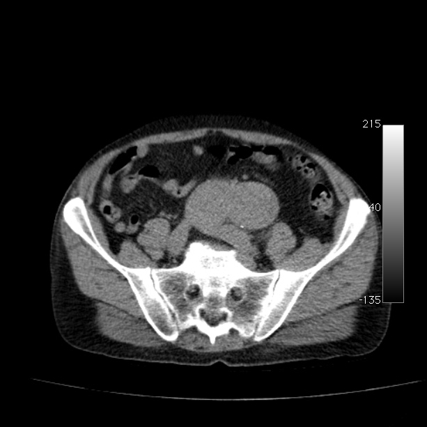 Abdominal aortic aneurysm (Radiopaedia 29248-29660 Axial non-contrast 42).jpg