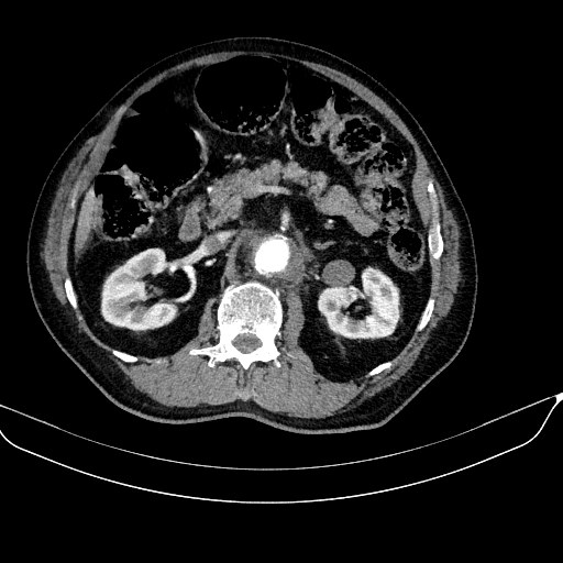 Abdominal aortic aneurysm (Radiopaedia 67117-76452 Axial C+ arterial phase 55).jpg