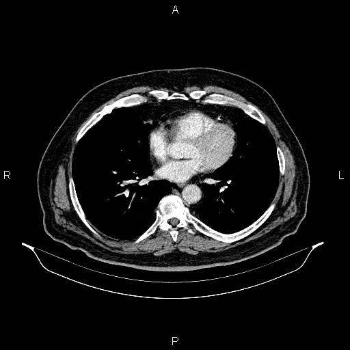 Abdominal aortic aneurysm (Radiopaedia 83094-97462 Axial renal cortical phase 47).jpg