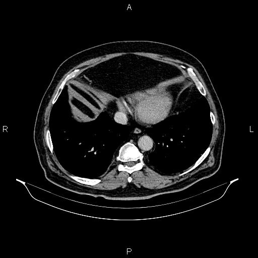 File:Abdominal aortic aneurysm (Radiopaedia 83094-97462 Axial renal excretory phase 10).jpg