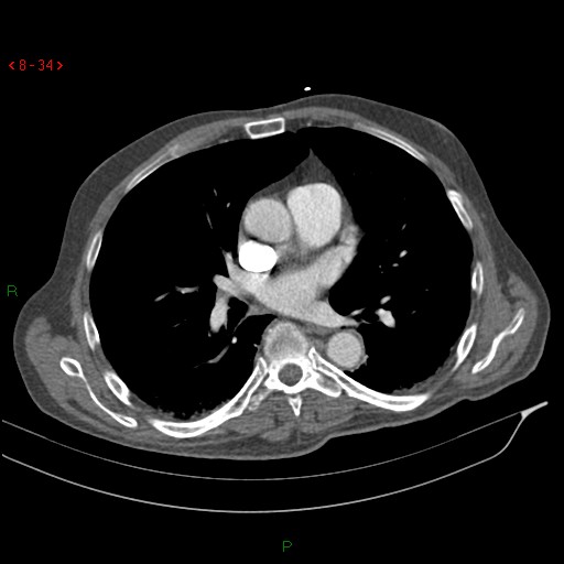 Abdominal aortic aneurysm rupture with aortocaval fistula (Radiopaedia 14897-14841 Axial C+ arterial phase 34).jpg