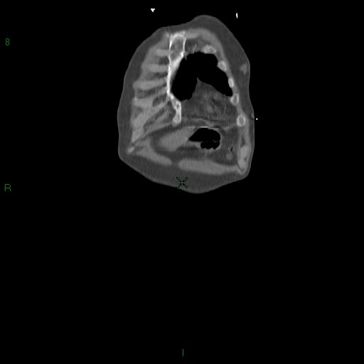 File:Abdominal aortic aneurysm rupture with aortocaval fistula (Radiopaedia 14897-14841 Coronal C+ arterial phase 12).jpg