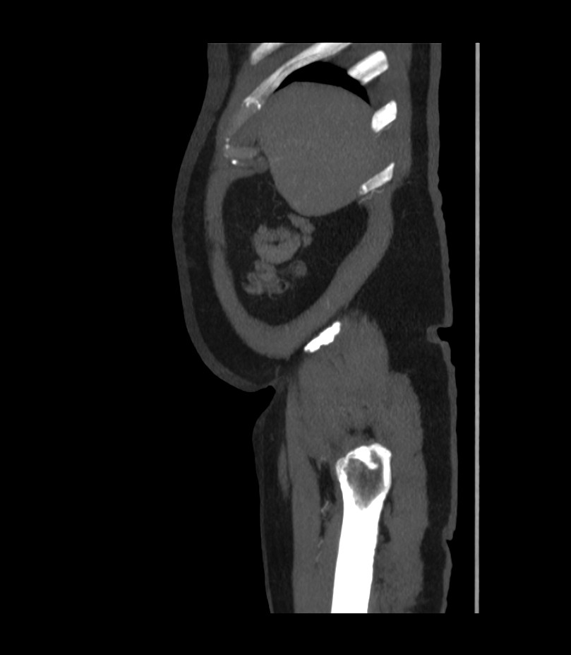Abdominal aortic aneurysm with thrombus fissuration (Radiopaedia 46218-50618 Sagittal C+ arterial phase 5).jpg