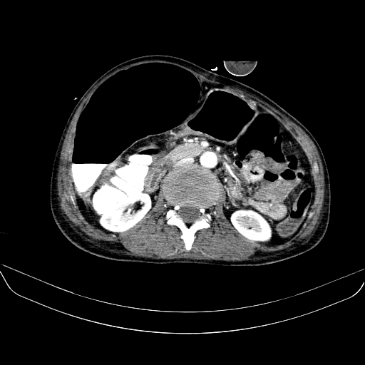 File:Abdominal collection due to previous cecal perforation (Radiopaedia 80831-94320 Axial C+ portal venous phase 90).jpg