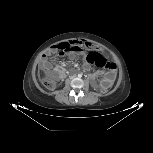 Abdominal gossypiboma- surgical towel (Radiopaedia 57288-64226 Axial C+ portal venous phase 37).jpg