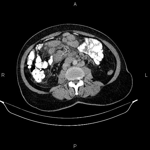 Abdominal lymphoma with sandwich sign (Radiopaedia 84378-99704 Axial C+ portal venous phase 32).jpg