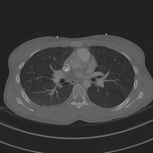 File:Abdominal multi-trauma - devascularised kidney and liver, spleen and pancreatic lacerations (Radiopaedia 34984-36486 I 41).png